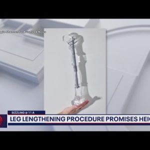 LION Lunch Hour: Leg lengthening procedure promises height for "short kings" | FOX 5 DC