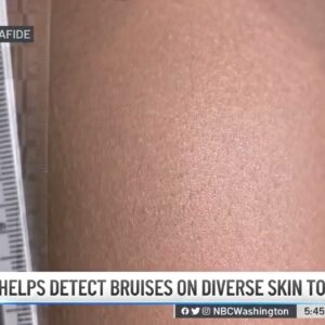 Technology Helps Detect Bruises on Diverse Skin Tones | NBC4 Washington