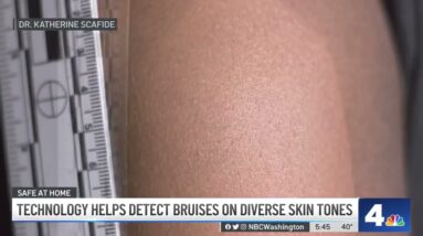 Technology Helps Detect Bruises on Diverse Skin Tones | NBC4 Washington